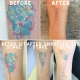 Tattoo removal on forearm