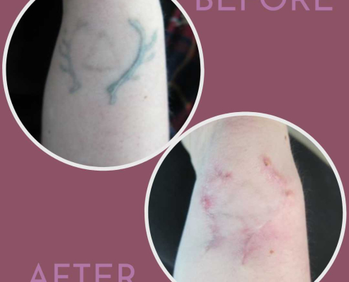 Tattoo removal on wrist