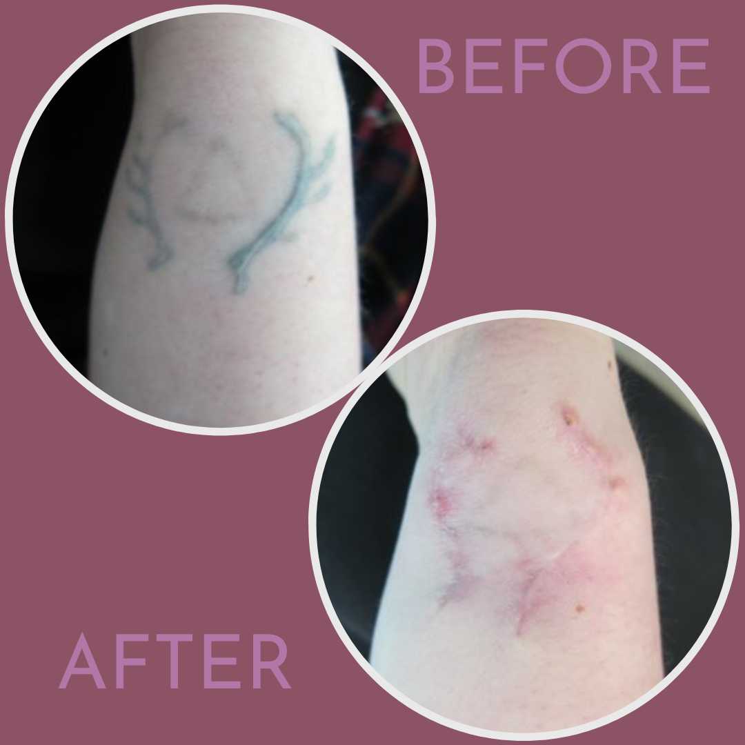 Laser Tattoo Removal - Las Vegas, Henderson, St George | Vivida Dermatology