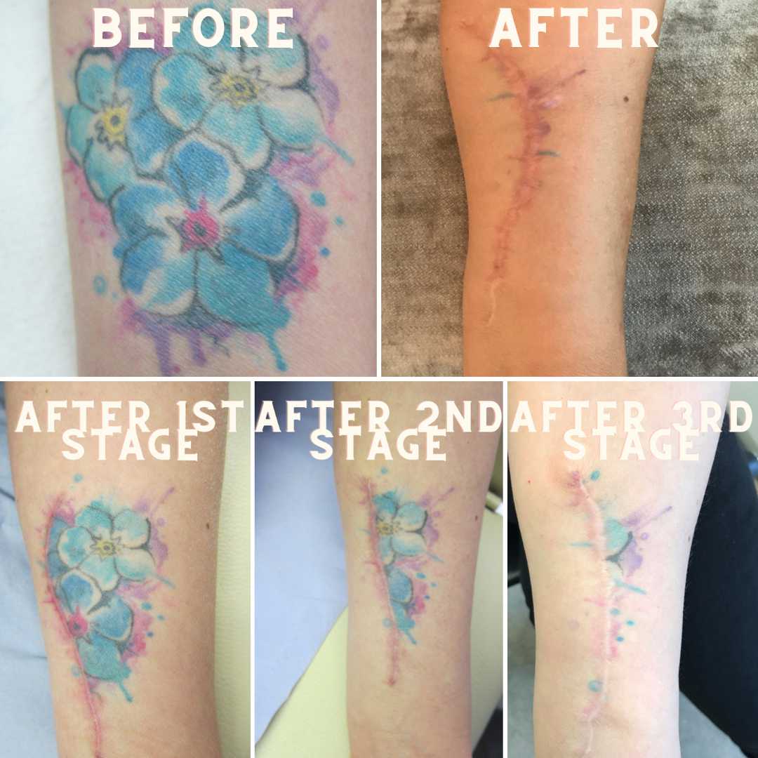 Laser Tattoo Removal ✨ #tattooremoval #tattooremovalspecialists  #lasertreatment #lasertattooremoval #Dermatology #dermatologist… | Instagram