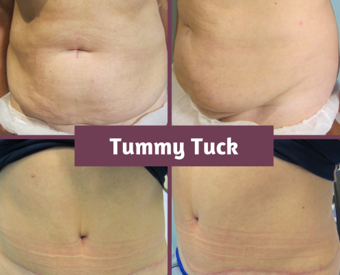 Tummy Tuck 4mths