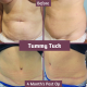 Tummy Tuck 4mths