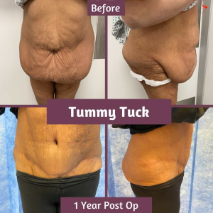 Tummy tuck 1 yr Tummy tuck 1yr