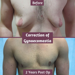 before and after gynaecomastia 2 years