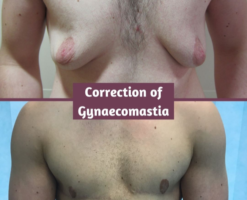 before and after gynaecomastia 2 years
