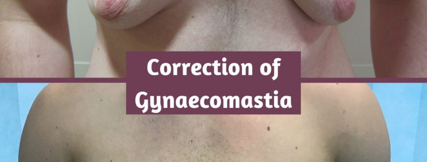 before and after gynaecomastia 2 years