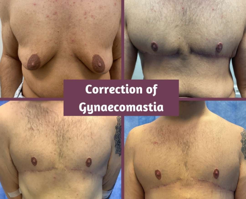 before and after gynaecomastia 9mths