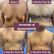 before and after gynaecomastia 9mths