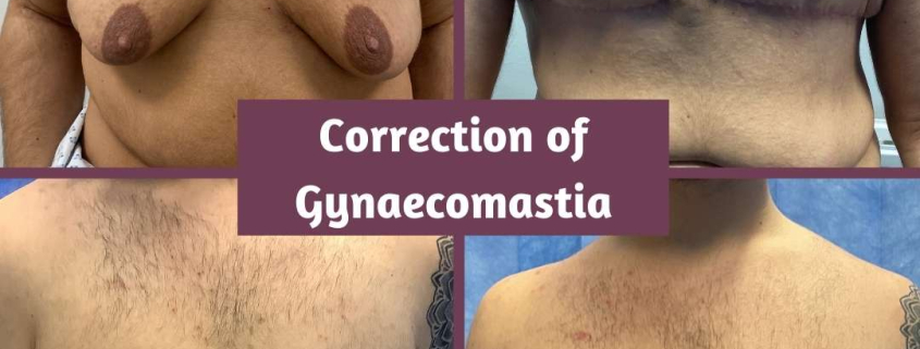 before and after gynaecomastia 9mths