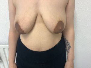 before areola reduction
