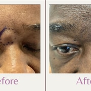 cyst between eyebrows marked before and after of cyst removal between eyebrows