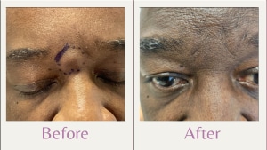 before and after of cyst removal between eyebrows