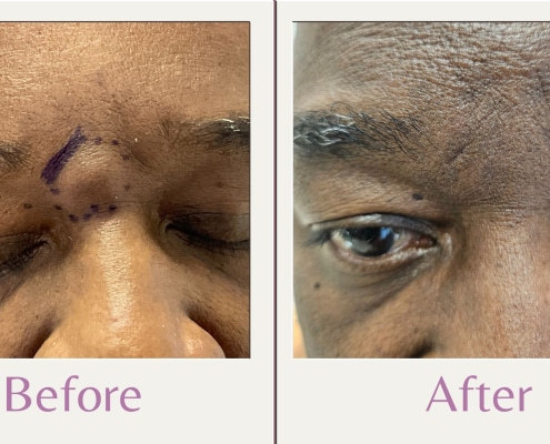 before and after of cyst removal between eyebrows