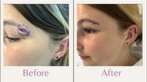 cyst on eyebrow (possible external angular dermoid) before and after of cyst removal from eyebrow