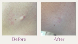 cyst on face Before and after photos of removal of cyst on face (cheek)