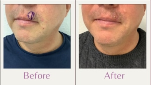 cyst on top lip Cyst on top lip before and after removal