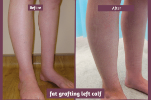 fat grafting before and after