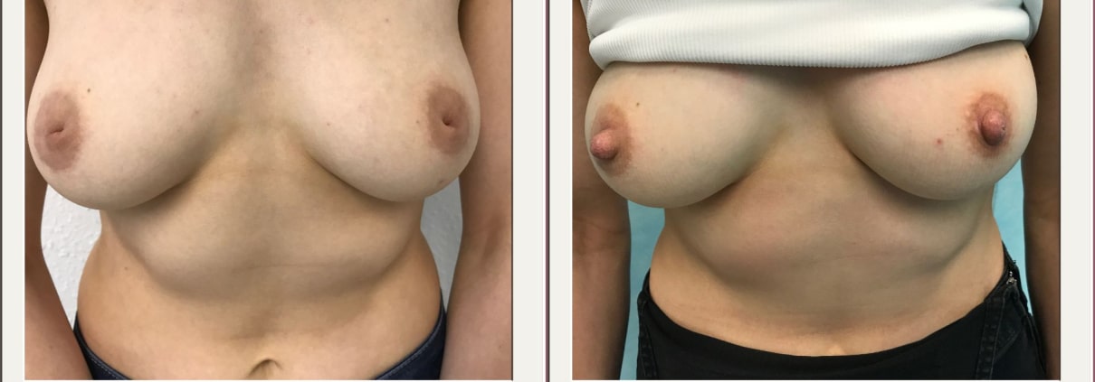 before and after photo of inverted nipple surgery