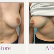 before and after photo of inverted nipple surgery