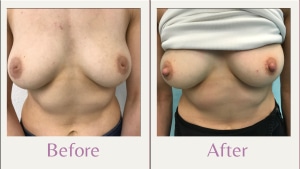 before and after photo of inverted nipple surgery