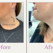 lipoma removal on neck