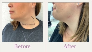 lipoma removal on neck