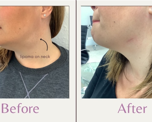 lipoma removal on neck