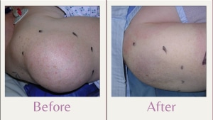 lipoma on shoulder liposuction