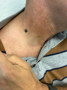 skin cancer on neck before