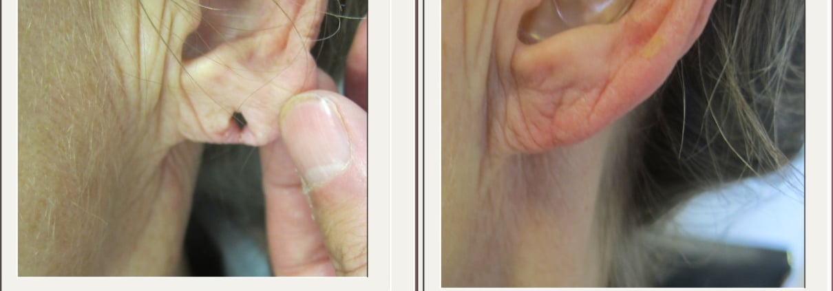 split earlobe repair