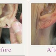 spit earlobe repair split earlobe repair