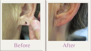 split earlobe repair
