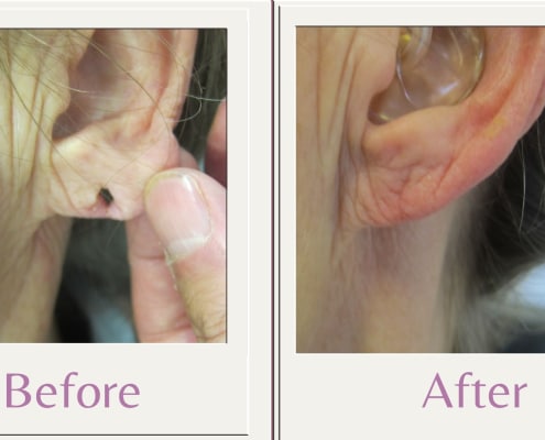 split earlobe repair