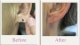 split earlobe repair