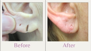 split earlobe repair with flap