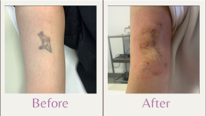 surgical tattoo removal on arm 1 week