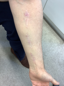 surgical tattoo removal on arm 2 years after