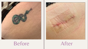 surgical tattoo removal on buttock 1 week