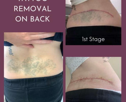 tattoo removal on back