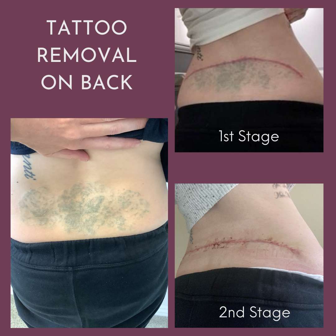 Before & After Laser Tattoo Removal Kirkland | Dr. Tseng