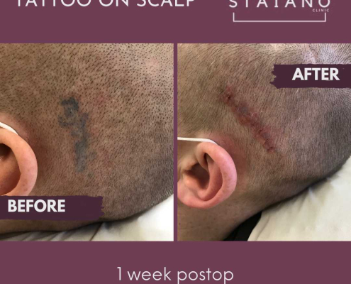 tattoo removal on scalp