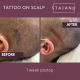 tattoo removal on scalp