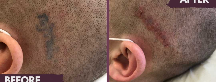 tattoo removal on scalp