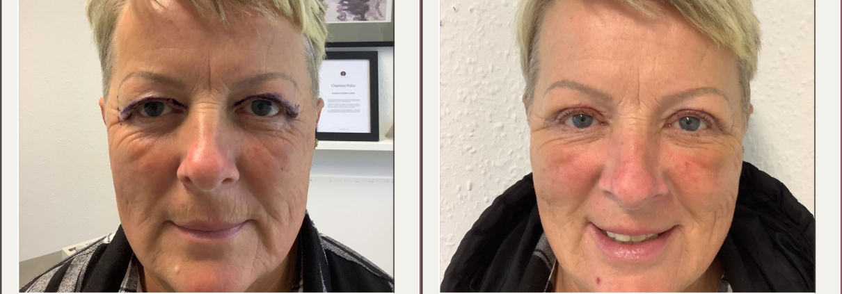 upper blepharoplasty at 1 week